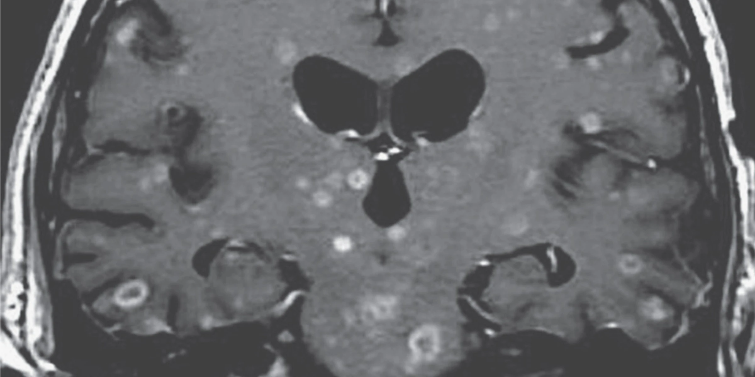 This MRI image of a skull shows diffuse contrast-enhancing lesions in the brain.